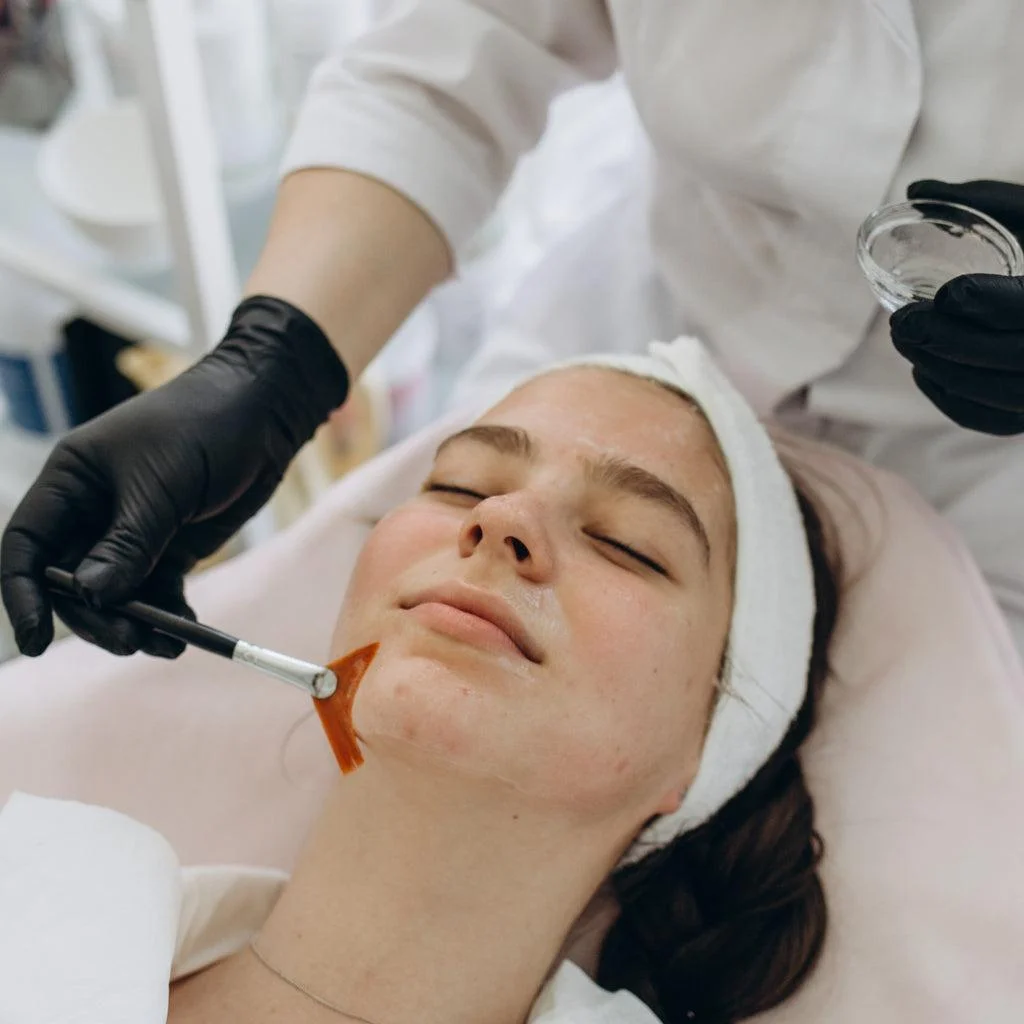 Chemical-Peels-1